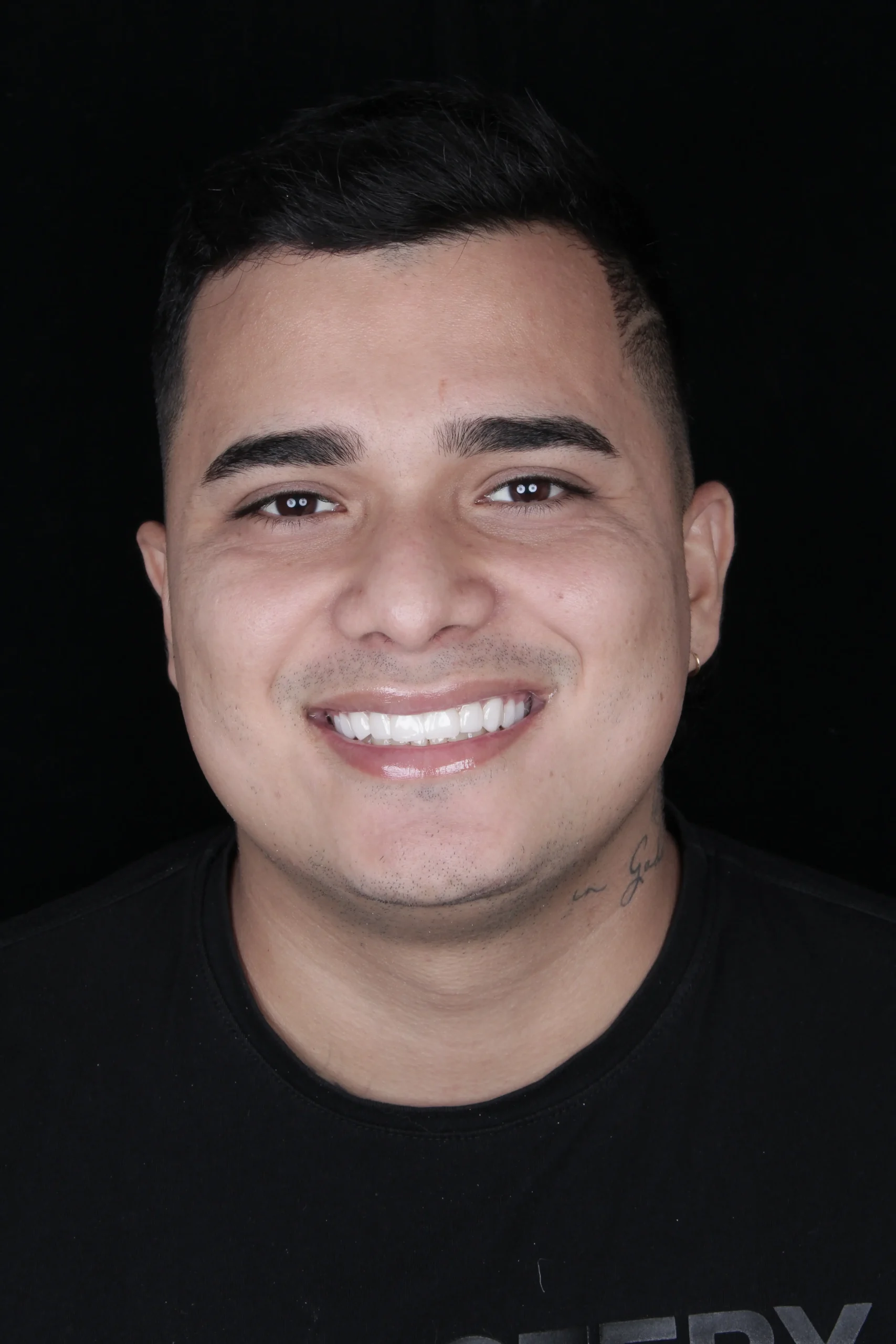 Diseño de sonrisa en resina y cerámica realizado en la Clínica Odontológica del Dr. Víctor Rodríguez en Bucaramanga.