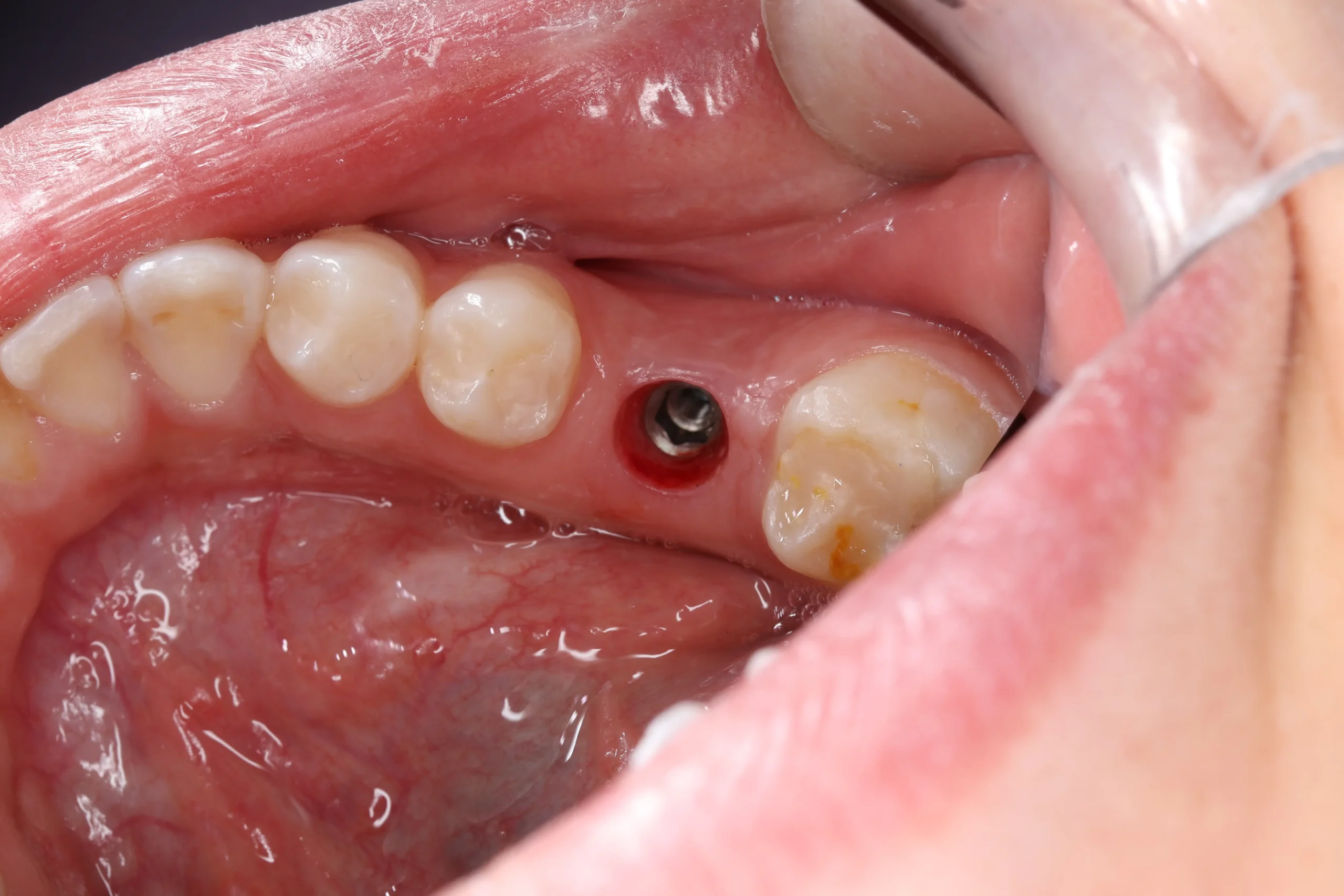 Colocación de implante dental en paciente en la Clínica Odontológica Víctor Rodríguez, procedimiento realizado con técnica avanzada para rehabilitación oral.