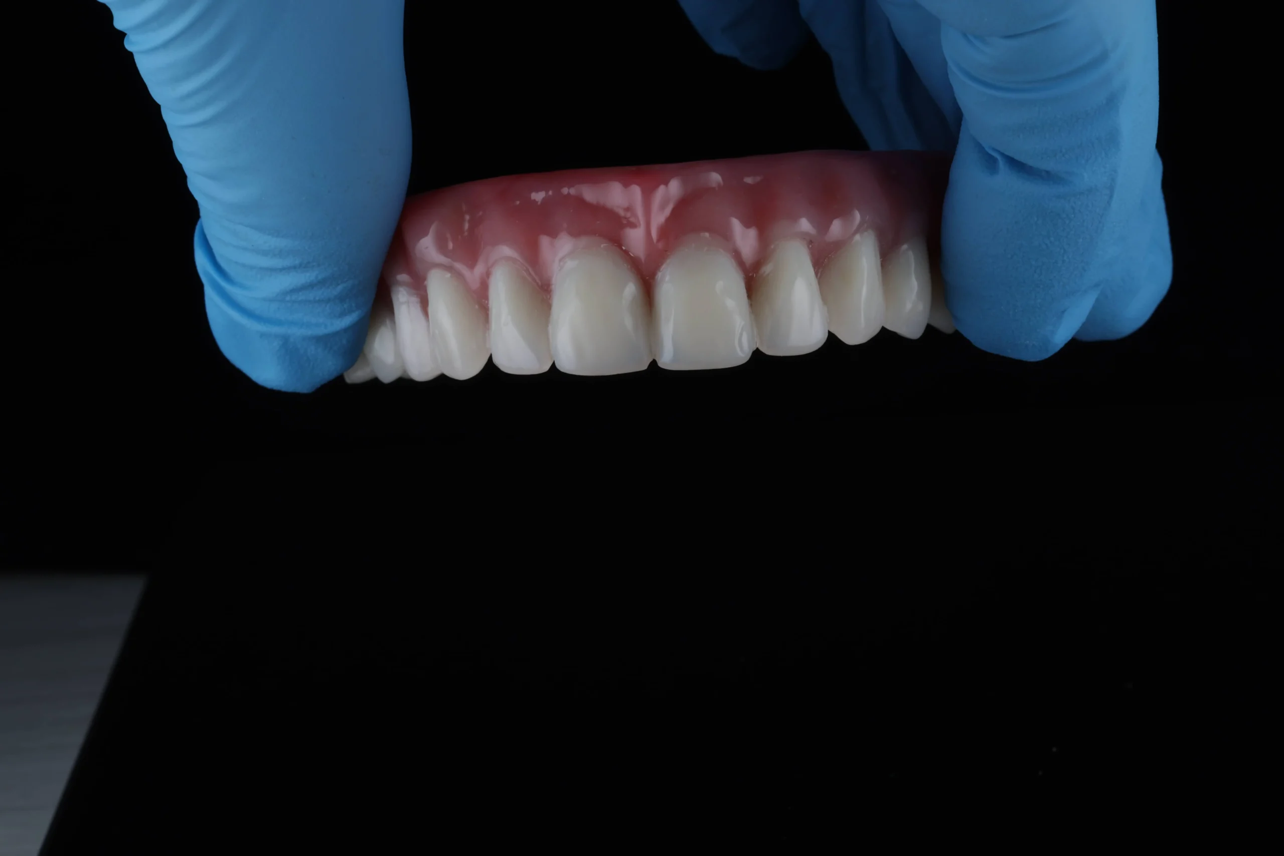 Prótesis híbrida fija para tratamiento All-on-4 — Clínica Odontológica Víctor Rodríguez en Bucaramanga