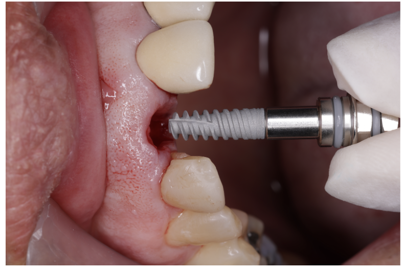 Colocación de implante dental mediante cirugía de implantología