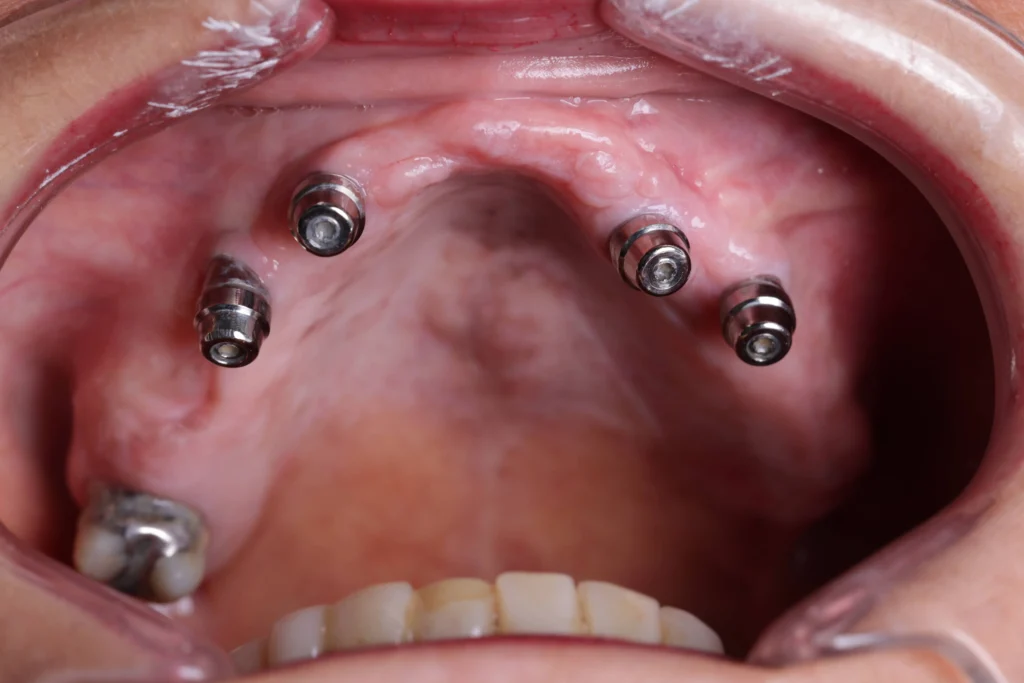 Colocación de implantes All-on-4 en maxilar superior — Clínica Odontológica Víctor Rodríguez en Bucaramanga