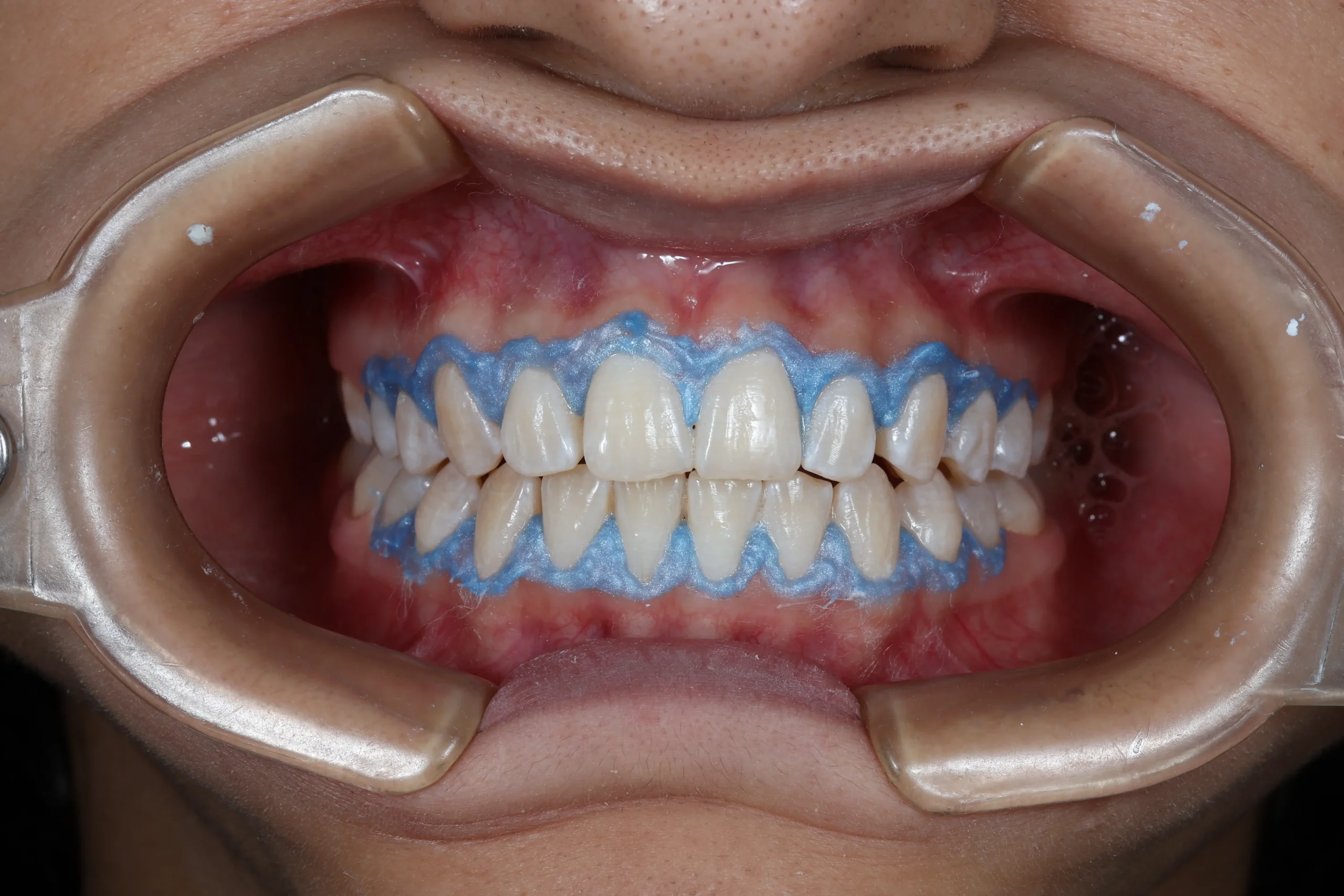 Limpieza dental profesional en odontología general realizada en Bucaramanga