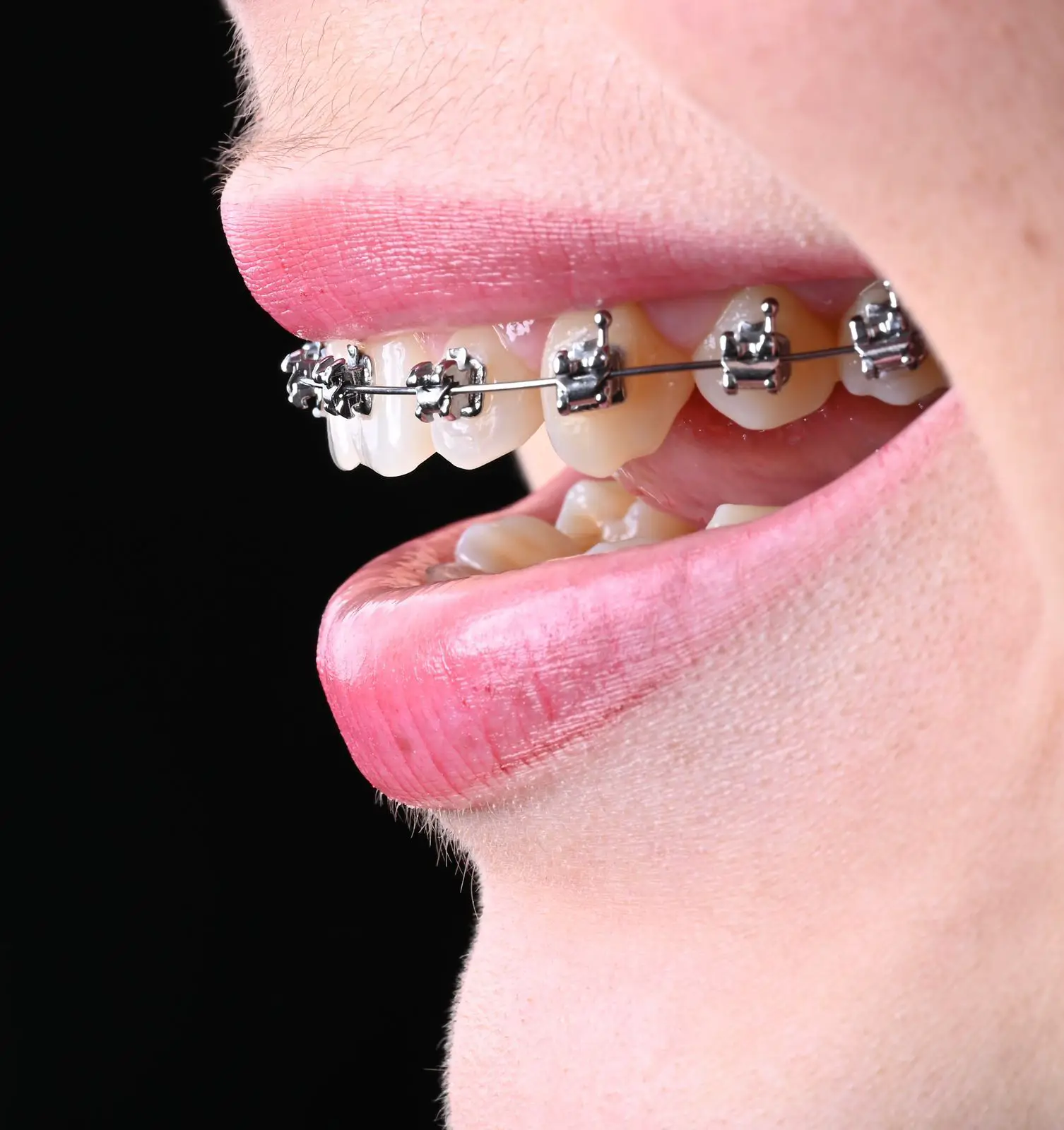 Paciente con brackets metálicos visibles en vista lateral durante tratamiento de ortodoncia dental
