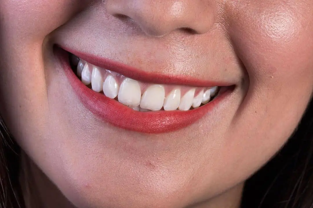 Diseño de sonrisa con resultados naturales en clínica dental especializada en Bucaramanga