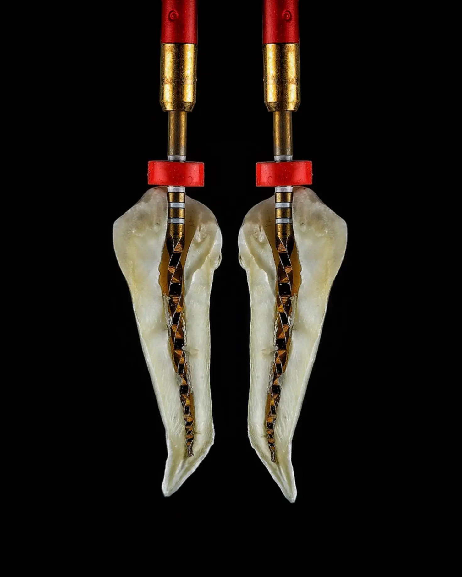 Endodoncia en molar para eliminar infección y salvar el diente natural.