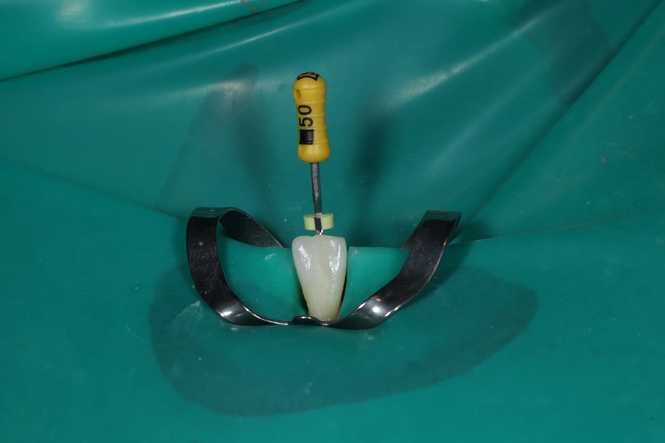 Limpieza y desinfección del conducto radicular durante una endodoncia.