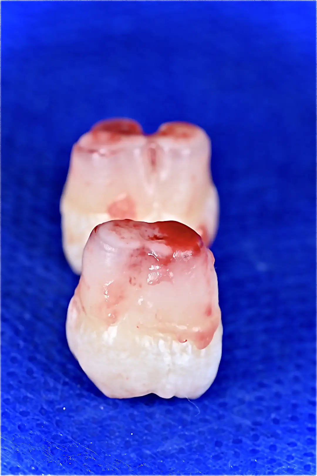 Molares extraídos durante procedimiento de cirugía oral tras extracción dental especializada