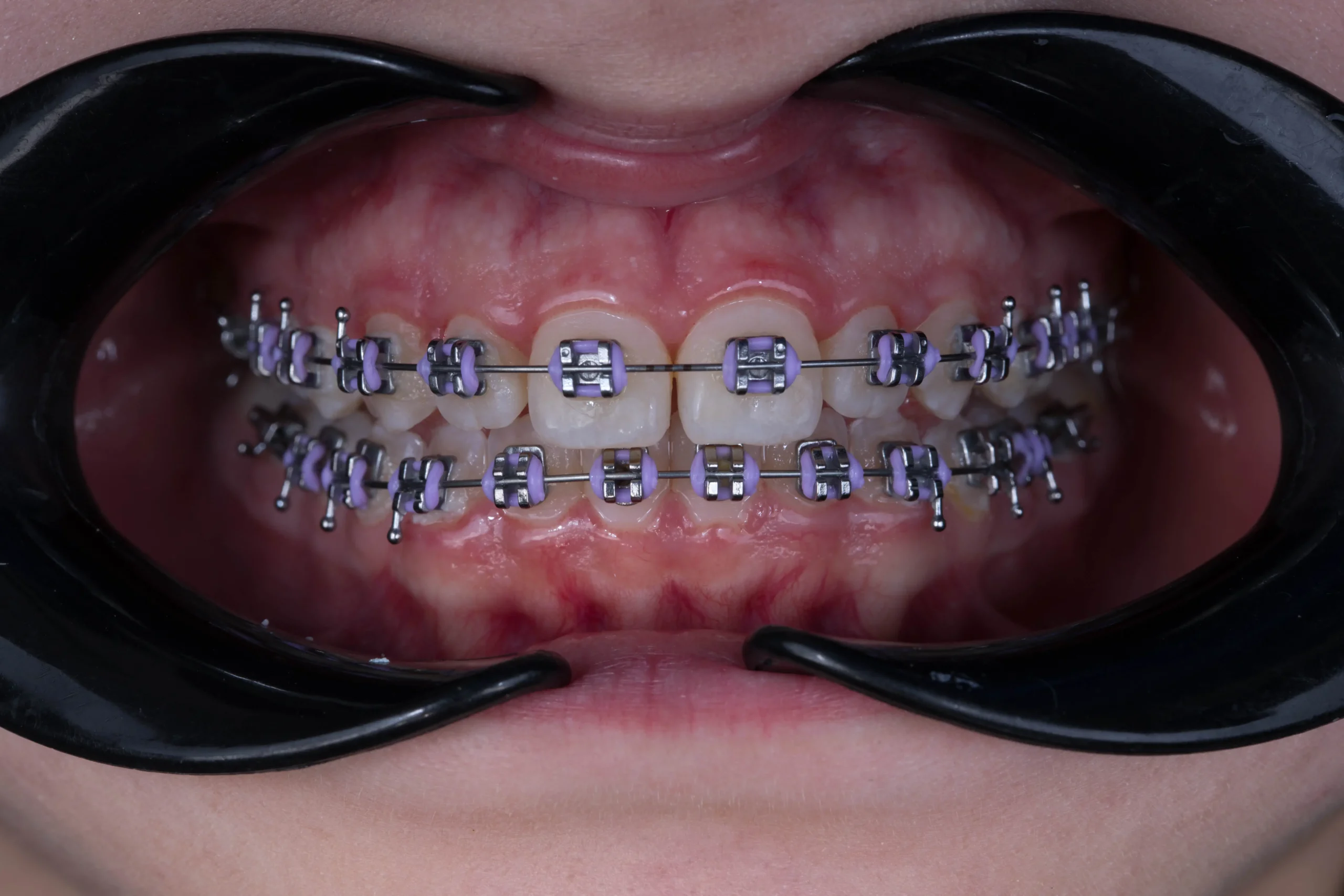 Tratamiento de ortodoncia con brackets metálicos realizado por especialista en Bucaramanga