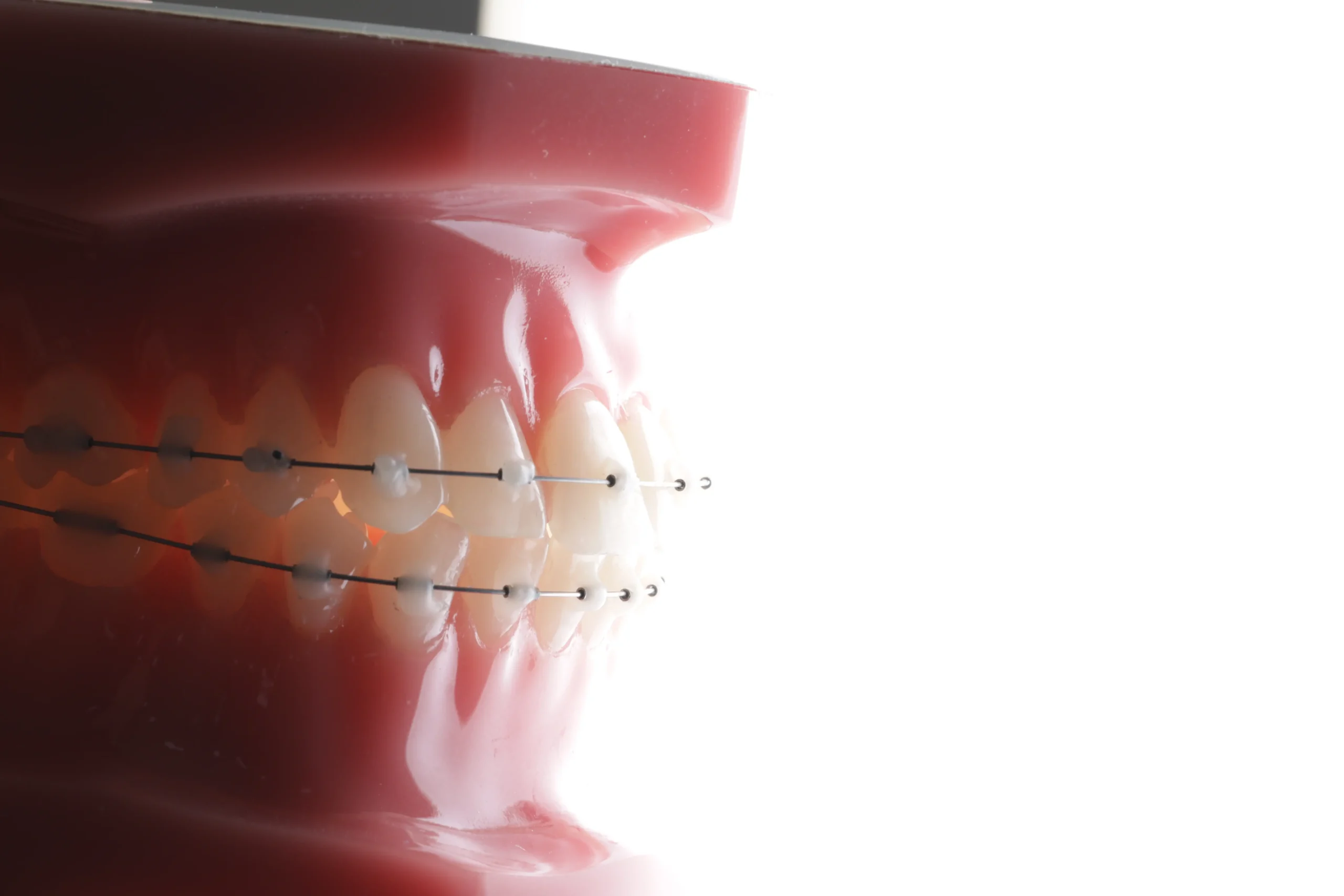 Modelo dental con tratamiento de ortodoncia y brackets para alineación dental en clínica odontológica de bucaramanga