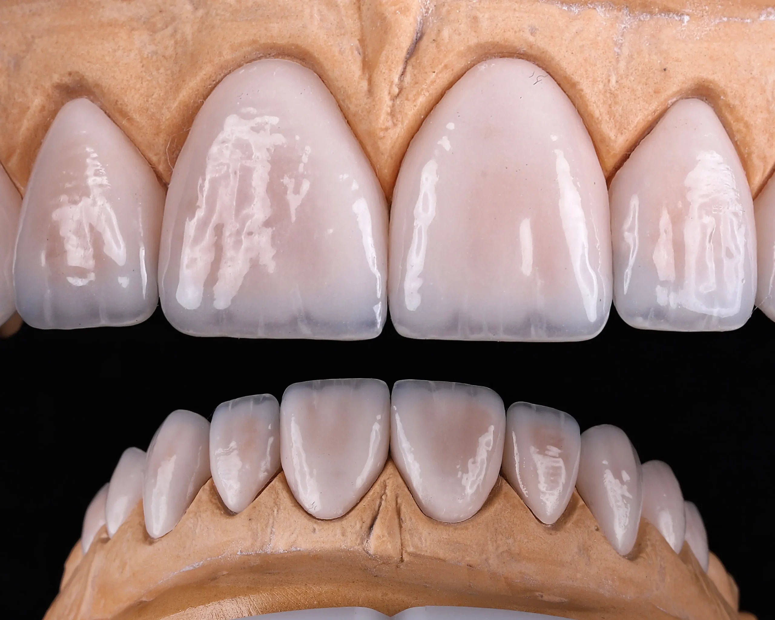 Carillas dentales cerámicas sobre modelo odontológico en tratamiento de rehabilitación oral y estética dental